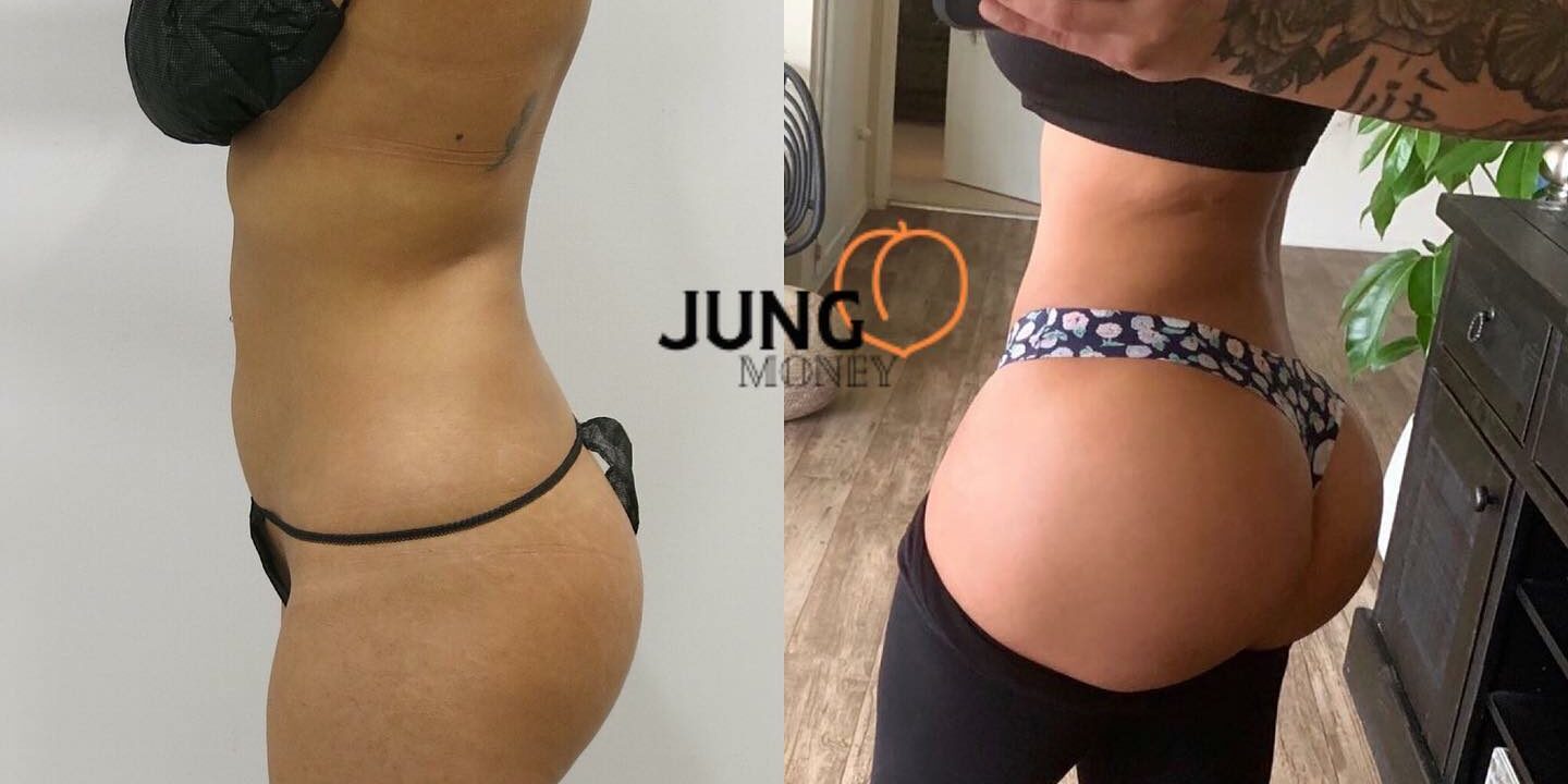 full-body-liposuction-houston-1440x720.jpg